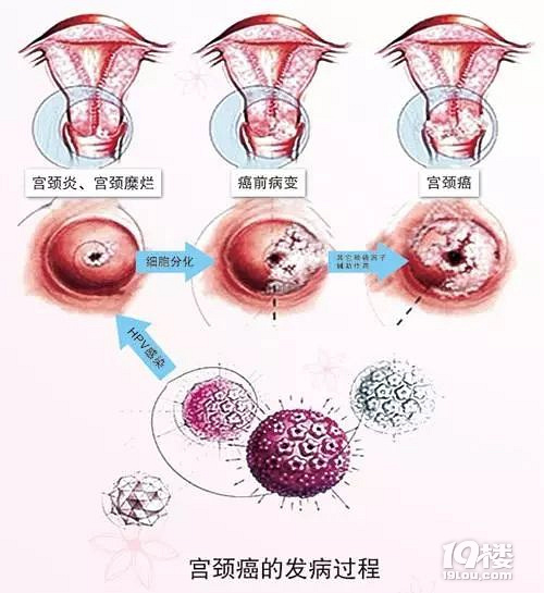 子宫颈癌悄无声息地夺走生命