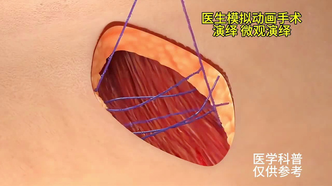 英国广播公司承认，在未能质疑哈里王子“缝合”的说法后，其编辑标准出现了失误